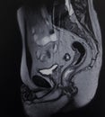 Mri exam rectum tumor pathology